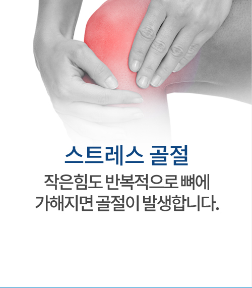 스트레스 골절 큰 힘이 뼈에 가해지면 부러지거나 골절이 발생합니다.